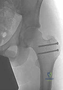 الفحص السريري الدقيق لألم الورك