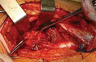 صورة توضيحية لـ خلع مفصل الفخذ الجراحي: حل متقدم لعلاج انحشار الفخذ الحقي (FAI) في صنعاء مع الأستاذ الدكتور محمد هطيف