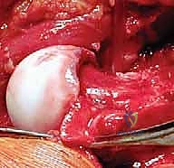 حماية الأوعية الدموية أثناء الجراحة