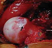 خلع مفصل الفخذ الجراحي: حل متقدم لعلاج انحشار الفخذ الحقي (FAI) في صنعاء مع الأستاذ الدكتور محمد هطيف