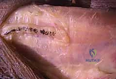 تقييم حالة اليد قبل جراحة تحويل الأوتار