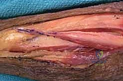 استخدام أجهزة تخطيط الأعصاب لتقييم الحالة