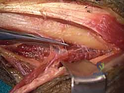 استخدام الجبائر المبدئية لدعم الرسغ