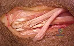 صورة توضيحية لـ شلل العصب الكعبري وتحويل الأوتار: استعادة حركة اليد والذراع مع الأستاذ الدكتور محمد هطيف في صنعاء