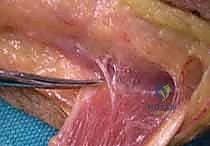 ضبط التوتر الدقيق للأوتار أثناء الجراحة