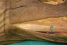 الخطوة الثانية: تجهيز الأوتار الباسطة للأصابع