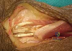 صورة طبية: شلل العصب الكعبري وتحويل الأوتار: استعادة حركة اليد والذراع مع الأستاذ الدكتور محمد هطيف في صنعاء