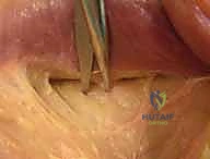 التشريح الدقيق للعصب الكعبري في الذراع