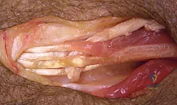 شلل العصب الكعبري وتحويل الأوتار: استعادة حركة اليد والذراع مع الأستاذ الدكتور محمد هطيف في صنعاء