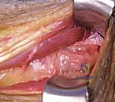 صورة طبية: شلل العصب الكعبري وتحويل الأوتار: استعادة حركة اليد والذراع مع الأستاذ الدكتور محمد هطيف في صنعاء