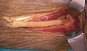 صورة طبية: شلل العصب الكعبري وتحويل الأوتار: استعادة حركة اليد والذراع مع الأستاذ الدكتور محمد هطيف في صنعاء