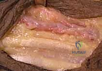 صورة توضيحية لـ شلل العصب الكعبري وتحويل الأوتار: استعادة حركة اليد والذراع مع الأستاذ الدكتور محمد هطيف في صنعاء