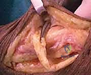 الخطوة الثالثة: خياطة وتر الإبهام بدقة ميكروسكوبية