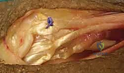 صورة طبية: شلل العصب الكعبري وتحويل الأوتار: استعادة حركة اليد والذراع مع الأستاذ الدكتور محمد هطيف في صنعاء