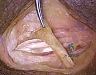 صورة توضيحية لـ شلل العصب الكعبري وتحويل الأوتار: استعادة حركة اليد والذراع مع الأستاذ الدكتور محمد هطيف في صنعاء