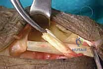 Radial Nerve Palsy Tendon Transfers: An Intraoperative Masterclass