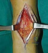 تشريح مفصل الكاحل المعقد