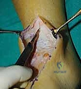 تثبيت مفصل الكاحل الأمامي: حل فعال لخشونة الكاحل المزمنة مع الأستاذ الدكتور محمد هطيف