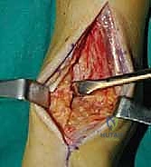 تآكل الغضاريف في الكاحل