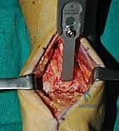 التغيرات المرضية في مفصل الكاحل