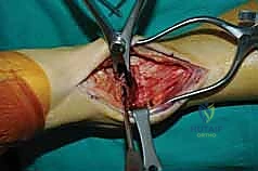 فحص الكاحل السريري