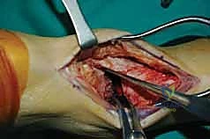 صورة توضيحية لـ تثبيت مفصل الكاحل الأمامي: حل فعال لخشونة الكاحل المزمنة مع الأستاذ الدكتور محمد هطيف