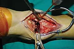 صورة توضيحية لـ تثبيت مفصل الكاحل الأمامي: حل فعال لخشونة الكاحل المزمنة مع الأستاذ الدكتور محمد هطيف