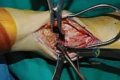 المدخل الأمامي لجراحة الكاحل