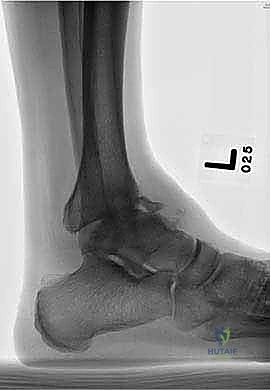 صورة توضيحية لـ تثبيت مفصل الكاحل الأمامي: حل فعال لخشونة الكاحل المزمنة مع الأستاذ الدكتور محمد هطيف