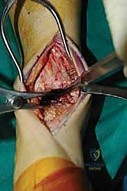 صورة توضيحية لـ تثبيت مفصل الكاحل الأمامي: حل فعال لخشونة الكاحل المزمنة مع الأستاذ الدكتور محمد هطيف