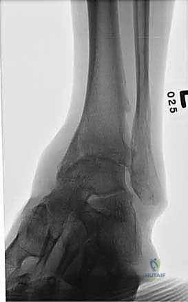 صورة توضيحية لـ تثبيت مفصل الكاحل الأمامي: حل فعال لخشونة الكاحل المزمنة مع الأستاذ الدكتور محمد هطيف