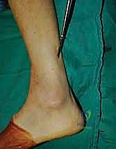 صورة توضيحية لـ تثبيت مفصل الكاحل الأمامي: حل فعال لخشونة الكاحل المزمنة مع الأستاذ الدكتور محمد هطيف