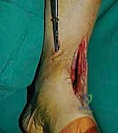 صورة توضيحية لـ تثبيت مفصل الكاحل الأمامي: حل فعال لخشونة الكاحل المزمنة مع الأستاذ الدكتور محمد هطيف