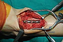 صورة توضيحية لـ تثبيت مفصل الكاحل الأمامي: حل فعال لخشونة الكاحل المزمنة مع الأستاذ الدكتور محمد هطيف