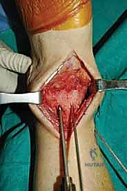 Intraoperative Surgical Step