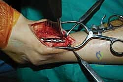 صورة طبية: تثبيت مفصل الكاحل الأمامي: حل فعال لخشونة الكاحل المزمنة مع الأستاذ الدكتور محمد هطيف