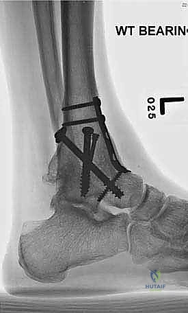 صورة طبية: تثبيت مفصل الكاحل الأمامي: حل فعال لخشونة الكاحل المزمنة مع الأستاذ الدكتور محمد هطيف