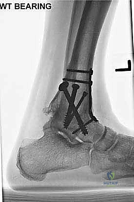 صورة طبية: تثبيت مفصل الكاحل الأمامي: حل فعال لخشونة الكاحل المزمنة مع الأستاذ الدكتور محمد هطيف