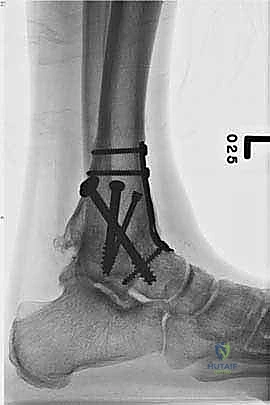 صورة طبية: تثبيت مفصل الكاحل الأمامي: حل فعال لخشونة الكاحل المزمنة مع الأستاذ الدكتور محمد هطيف