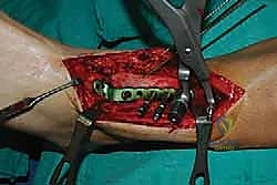 صورة طبية: تثبيت مفصل الكاحل الأمامي: حل فعال لخشونة الكاحل المزمنة مع الأستاذ الدكتور محمد هطيف