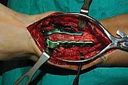 صورة طبية: تثبيت مفصل الكاحل الأمامي: حل فعال لخشونة الكاحل المزمنة مع الأستاذ الدكتور محمد هطيف