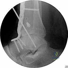 صورة طبية: تثبيت مفصل الكاحل الأمامي: حل فعال لخشونة الكاحل المزمنة مع الأستاذ الدكتور محمد هطيف