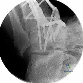 صورة طبية: تثبيت مفصل الكاحل الأمامي: حل فعال لخشونة الكاحل المزمنة مع الأستاذ الدكتور محمد هطيف