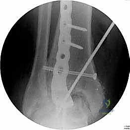 صورة طبية: تثبيت مفصل الكاحل الأمامي: حل فعال لخشونة الكاحل المزمنة مع الأستاذ الدكتور محمد هطيف