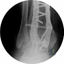 صورة طبية: تثبيت مفصل الكاحل الأمامي: حل فعال لخشونة الكاحل المزمنة مع الأستاذ الدكتور محمد هطيف