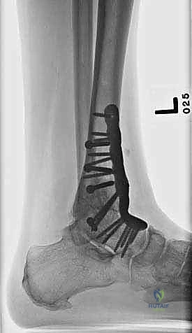 صورة طبية: تثبيت مفصل الكاحل الأمامي: حل فعال لخشونة الكاحل المزمنة مع الأستاذ الدكتور محمد هطيف