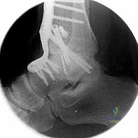 صورة طبية: تثبيت مفصل الكاحل الأمامي: حل فعال لخشونة الكاحل المزمنة مع الأستاذ الدكتور محمد هطيف