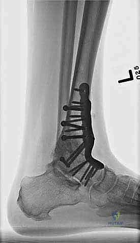 صورة طبية: تثبيت مفصل الكاحل الأمامي: حل فعال لخشونة الكاحل المزمنة مع الأستاذ الدكتور محمد هطيف