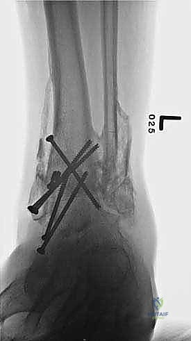 صورة طبية: تثبيت مفصل الكاحل الأمامي: حل فعال لخشونة الكاحل المزمنة مع الأستاذ الدكتور محمد هطيف