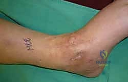 صورة طبية: تثبيت مفصل الكاحل الأمامي: حل فعال لخشونة الكاحل المزمنة مع الأستاذ الدكتور محمد هطيف